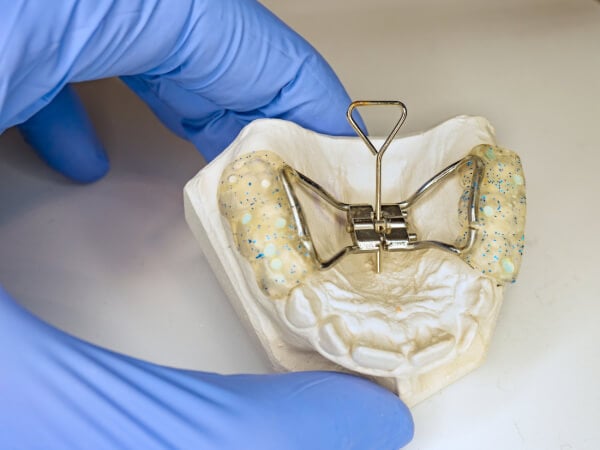 Dentist setting in fingers patient teeth model with Hyrax Expander braces known as rapid palatal expander